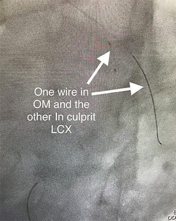Cardiology and Interventional Cardiology Guidewire in Left Circumflex Artery - During Stent